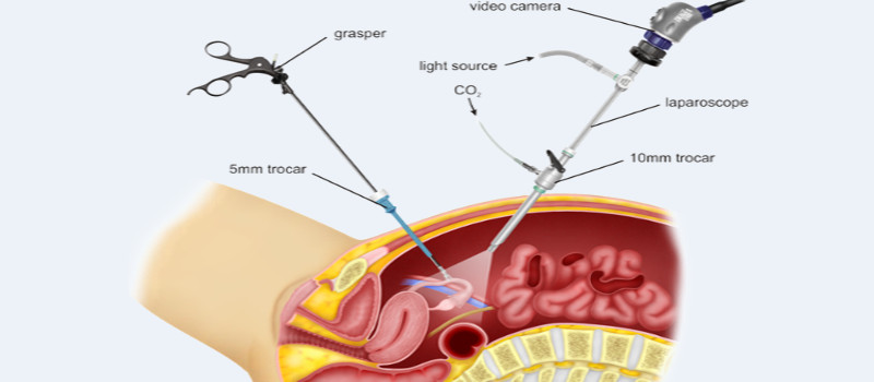 kidney stone disease 1